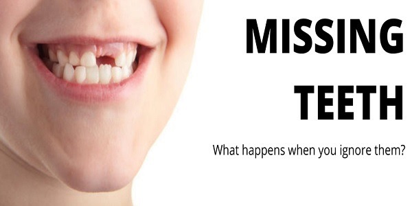 The Solution for Missing Teeth
