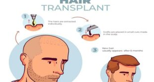 Hair Transplantation in Turkey